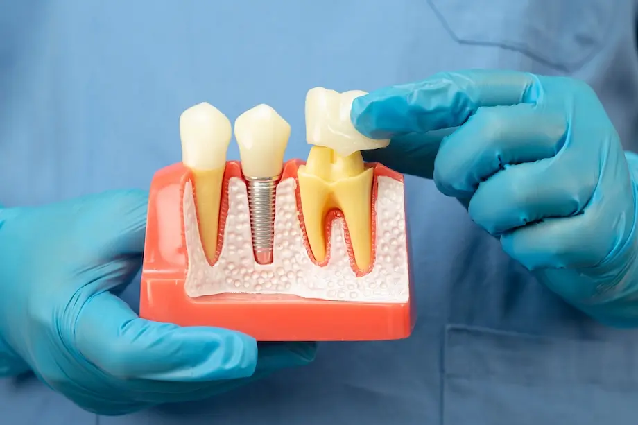asian dentist holding dental implant artificial t 2026 01 09 01 22 46 utc