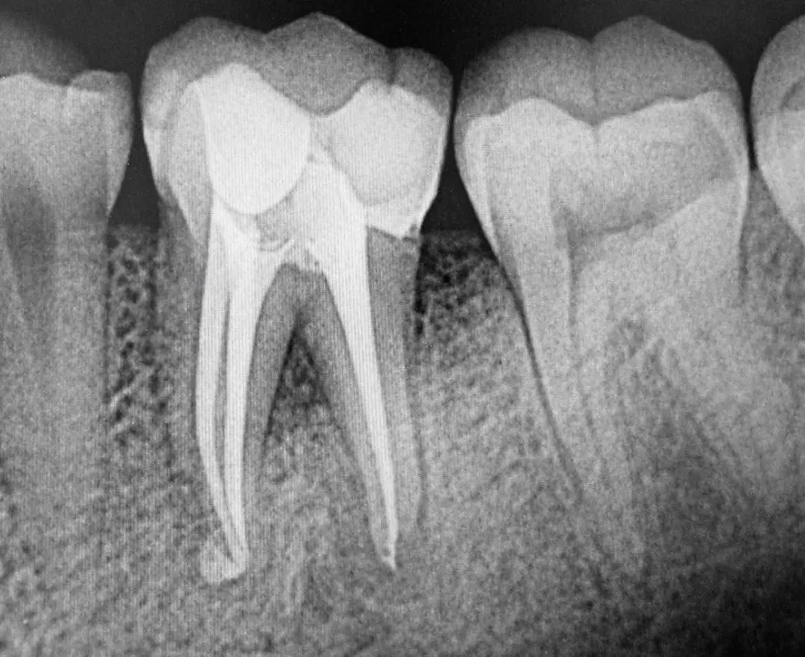 Case 1 After