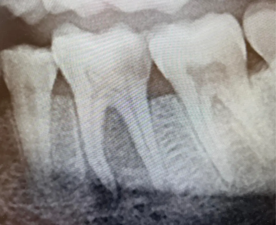 Case 1 Before Case 1 Before